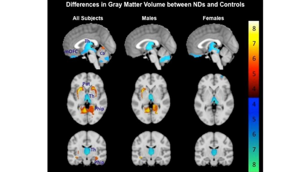 Diferencias en densidad de materia gris (coloreada) en consumidores de nicotina. Researchgate.net