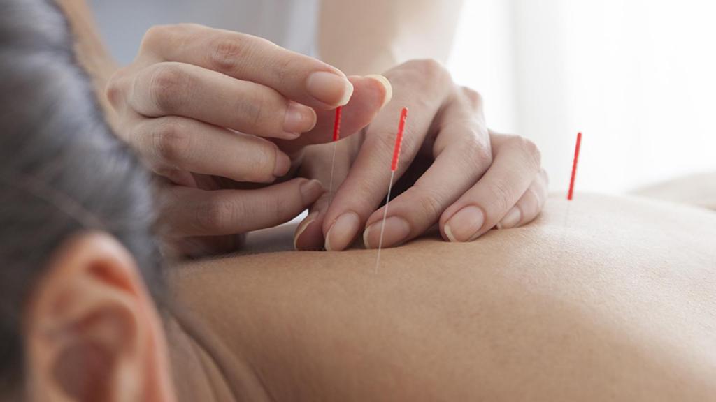 Una sesión de acupuntura.