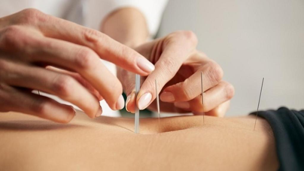 Una sesión de acupuntura en la espalda.