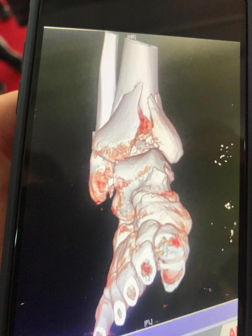 El tobillo de Crutchlow roto por 17 sitios