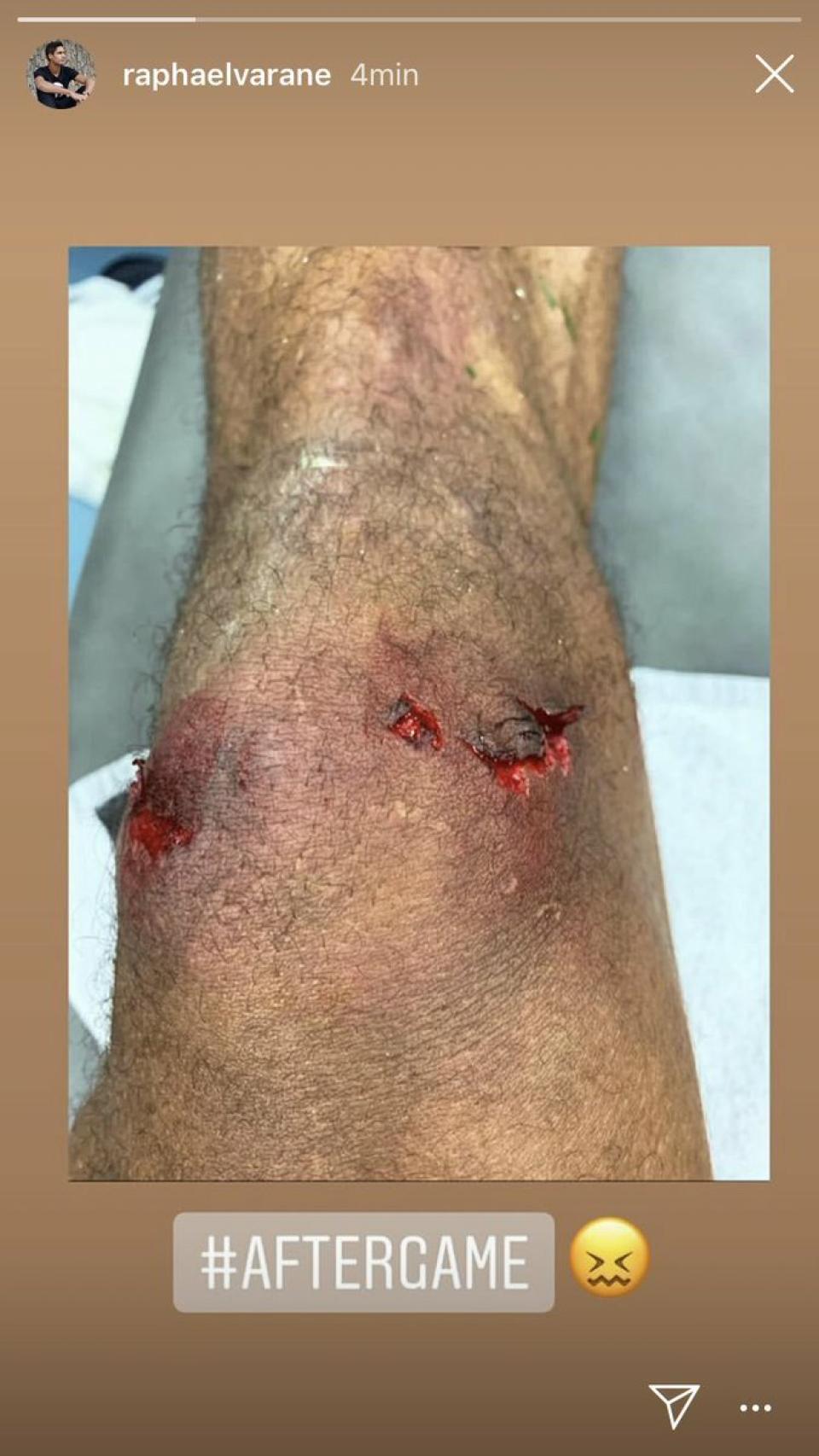 La rodilla de Varane