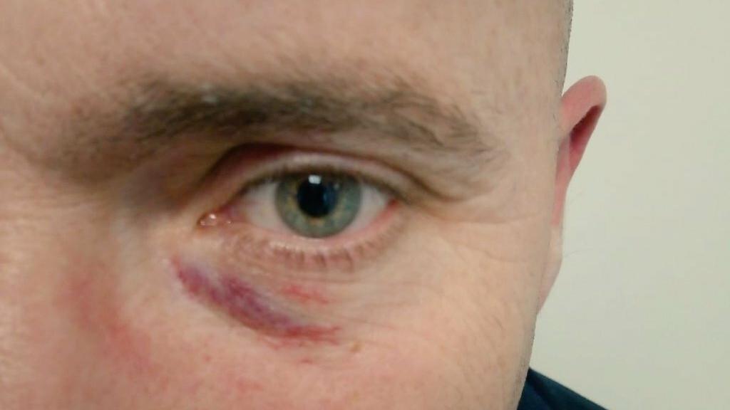 Lesiones causadas a Juan Manuel Rosales, coordinador local de Vox en Pontevedra.