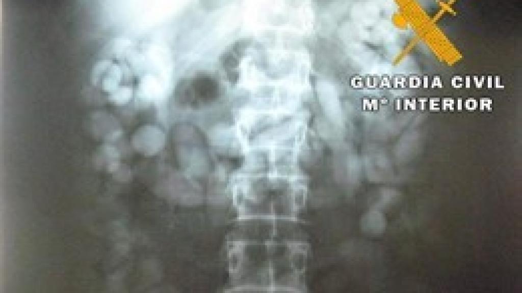 Radiografía del torso del hombre detenido