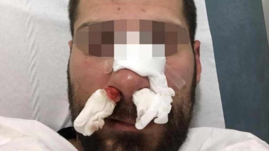 El agente de la UIP agredido en Melilla requirió de atención hospitalaria.