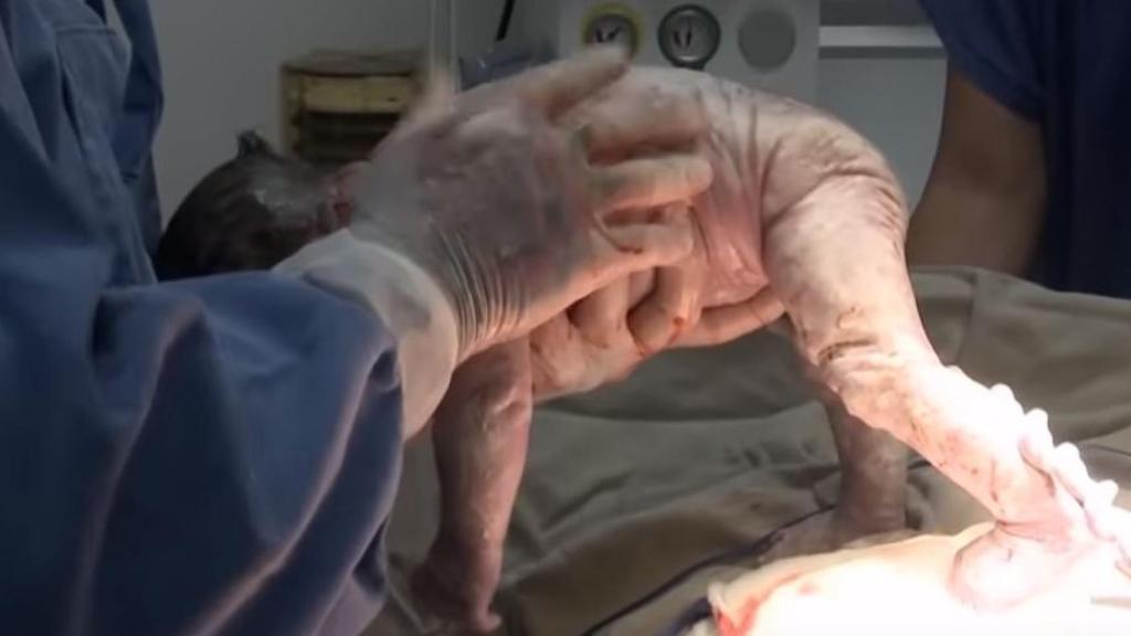 Video de la niña que nació con su gemelo dentro.