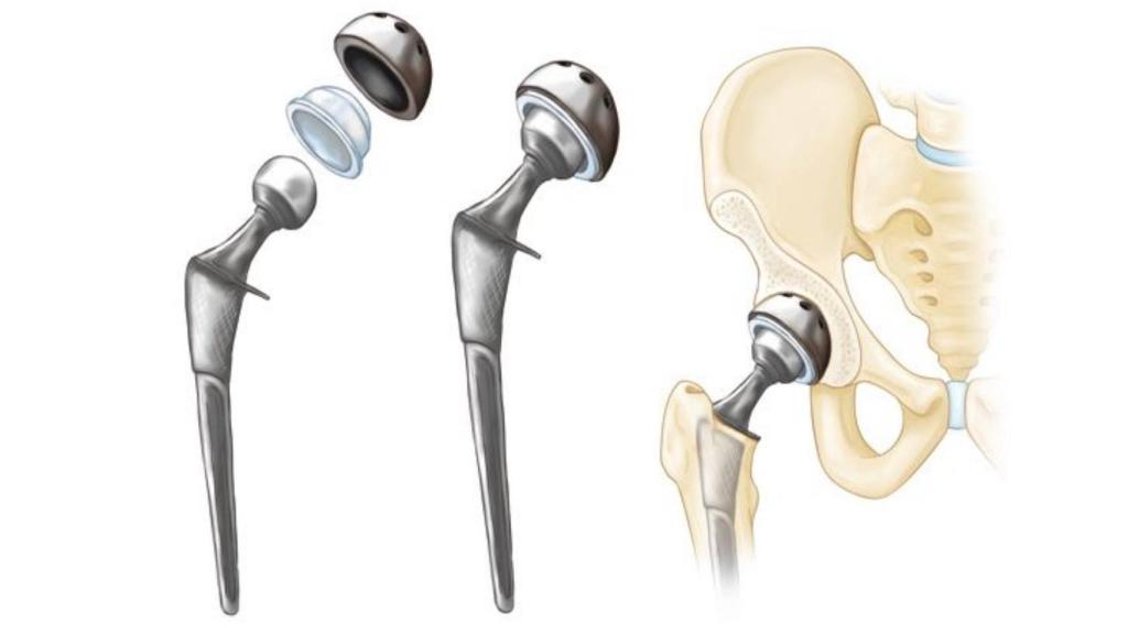 Diagrama de montaje de la prótesis de cadera.
