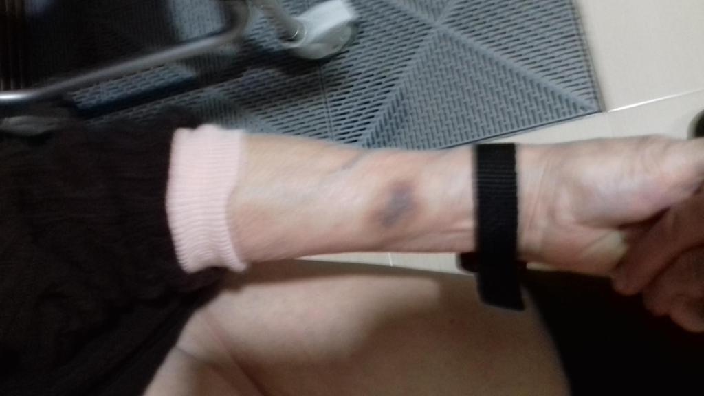 Hematoma que presentaba la madre de Francisco en el antebrazo.