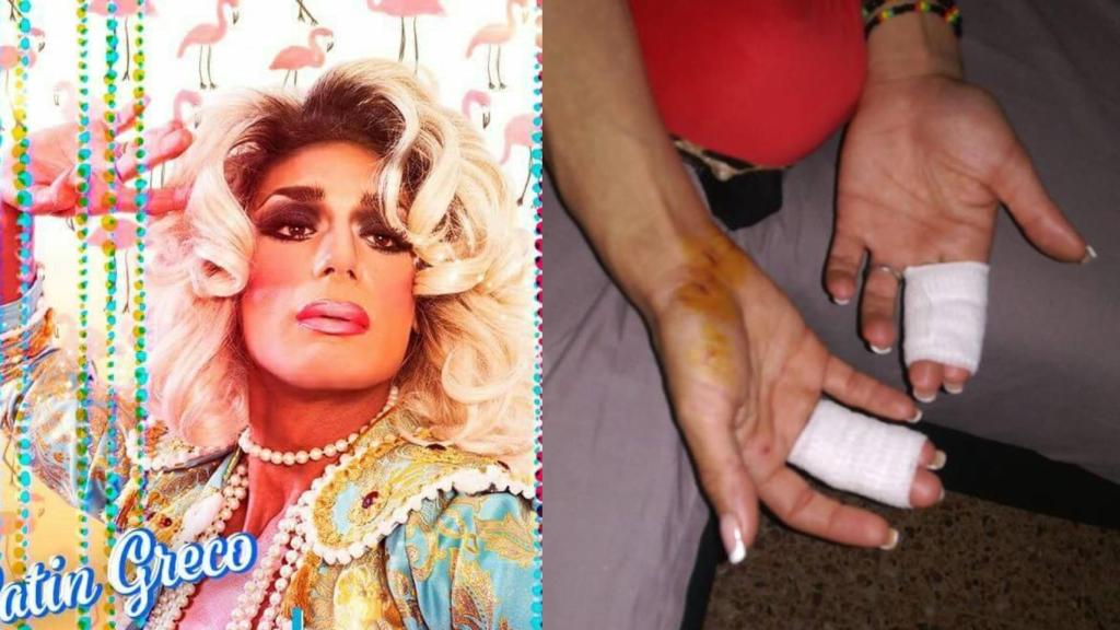 Satín Greco mostrando las heridas de la agresión