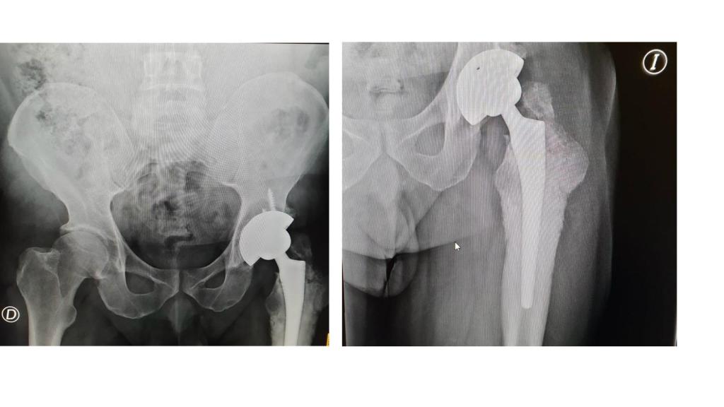 Prótesis de cadera de Pedro Pérez.