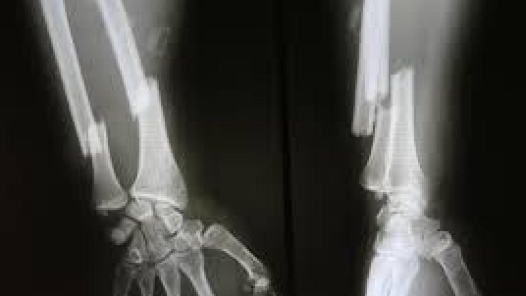 Una brazo con una fractura de radio y cúbito.