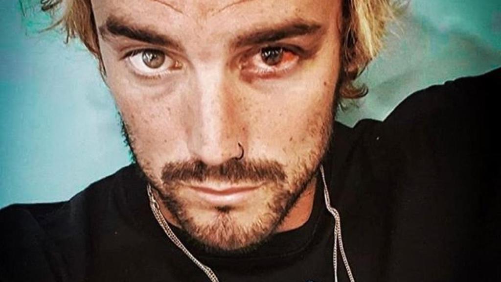 Logan muestra su ojo en una publicación de Instagram.