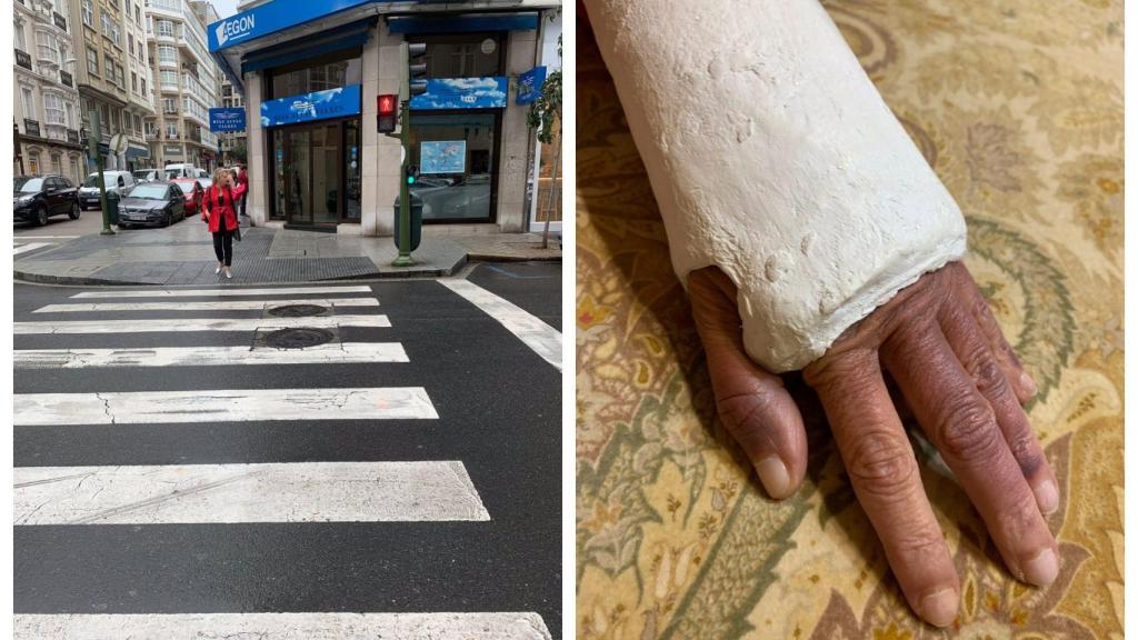 Peligro en el paso de cebra: una coruñesa cuenta cómo resbaló y se rompió la muñeca