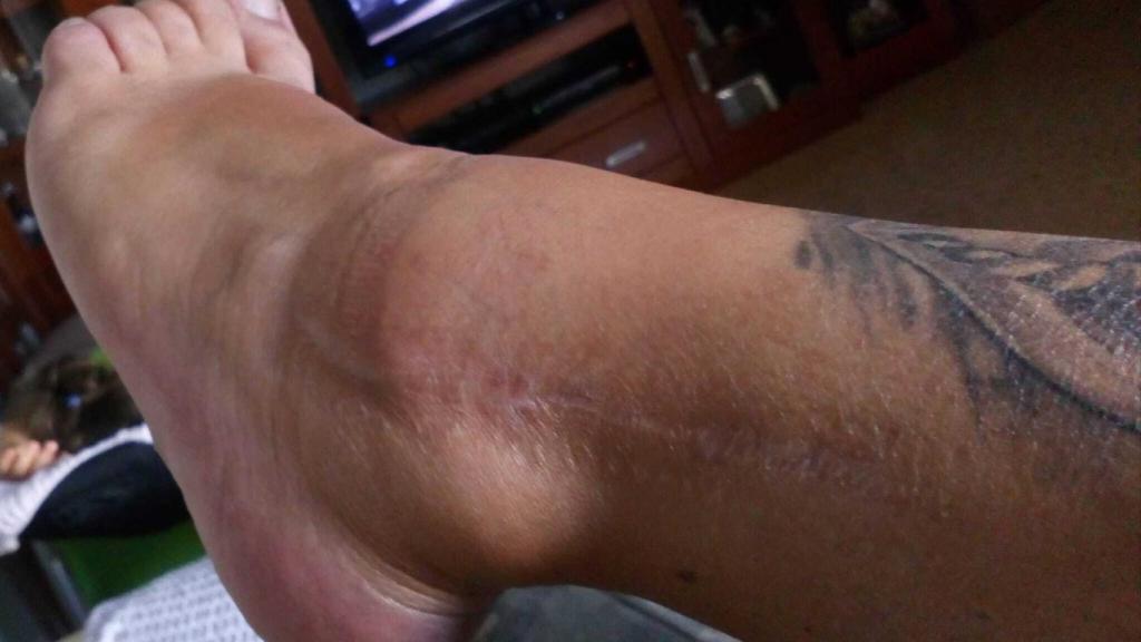 La pierna izquierda de Laura, donde sufrió las heridas tras su caída.