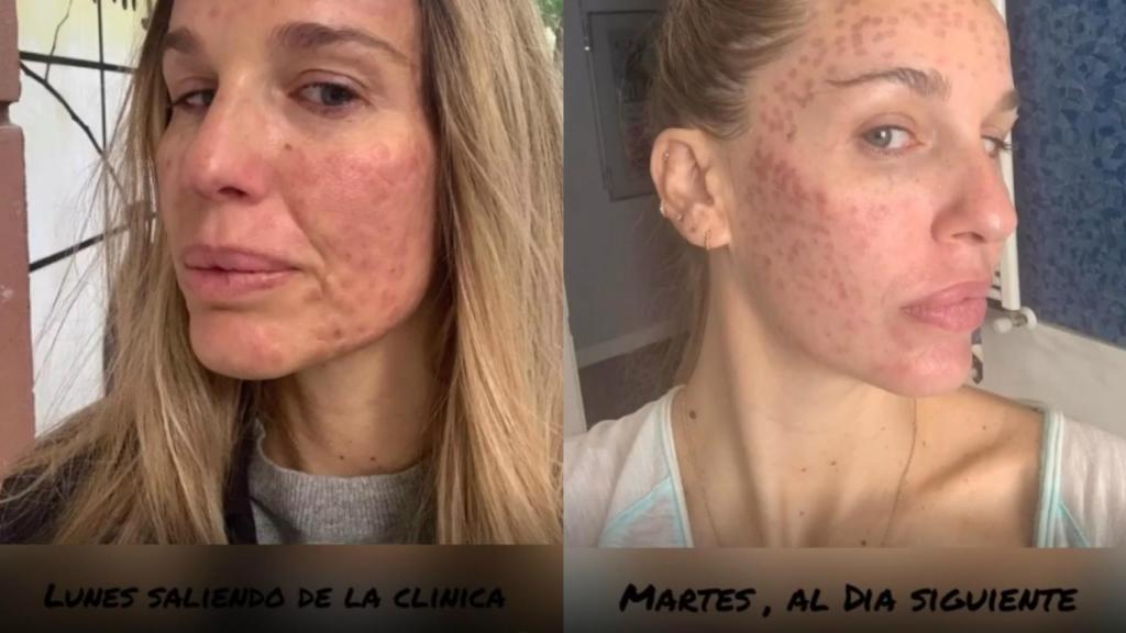 Carola ha mostrado cómo estaba su rostro al salir de la clínica y al día siguiente.