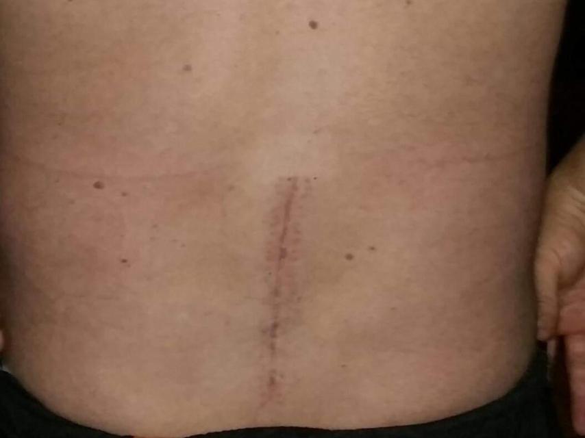 Secuelas de la lesión tras el accidente en la espalda del agente.