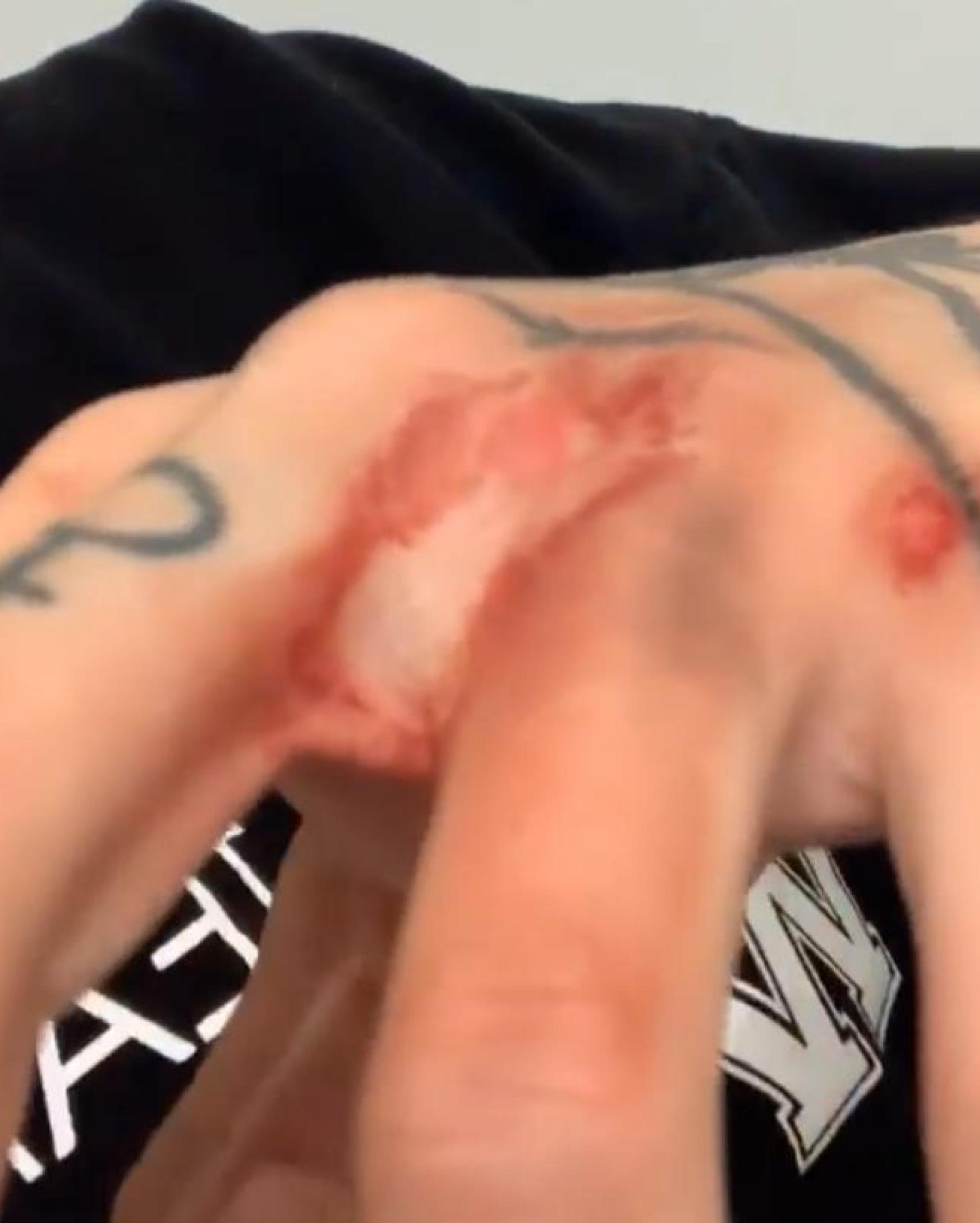 Valeria ha mostrado las heridas a través de sus redes sociales.