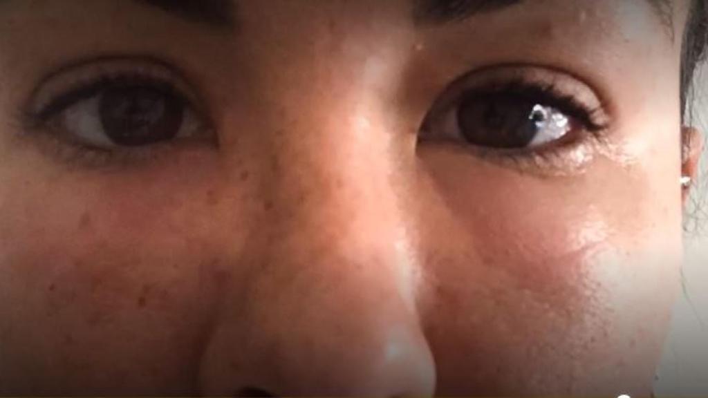 Susana con la cara hinchada después del tratamiento.