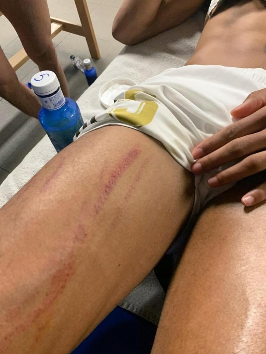 La herida en la pierna de Varane tras el partido