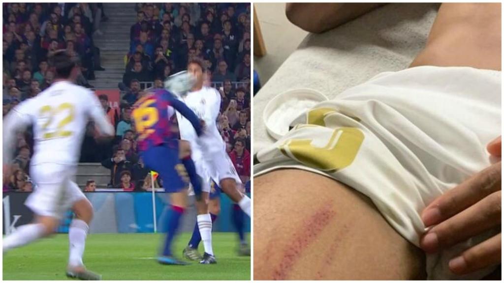 Así quedó el muslo de Varane tras la fuerte entrada de Lenglet en el penalti no pitado