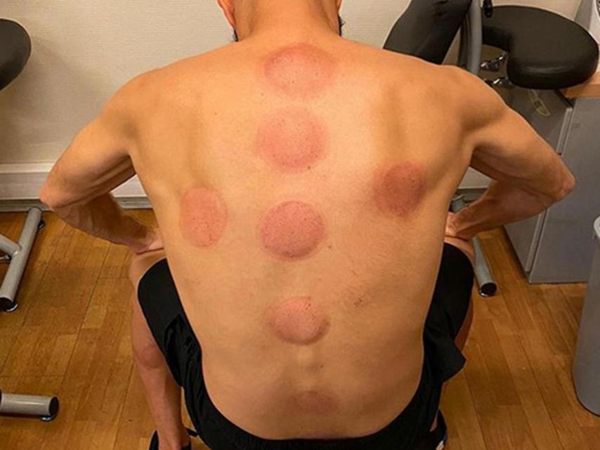 Karim Benzema en su última sesión de 'ventosaterapia' este miércoles