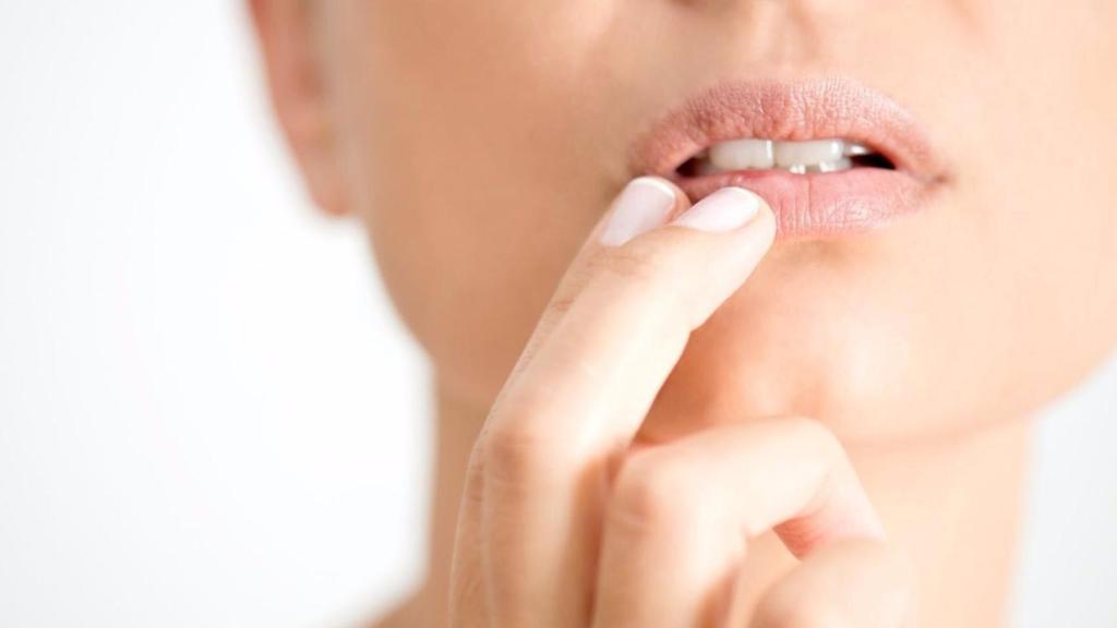 Imagen de un herpes labial.
