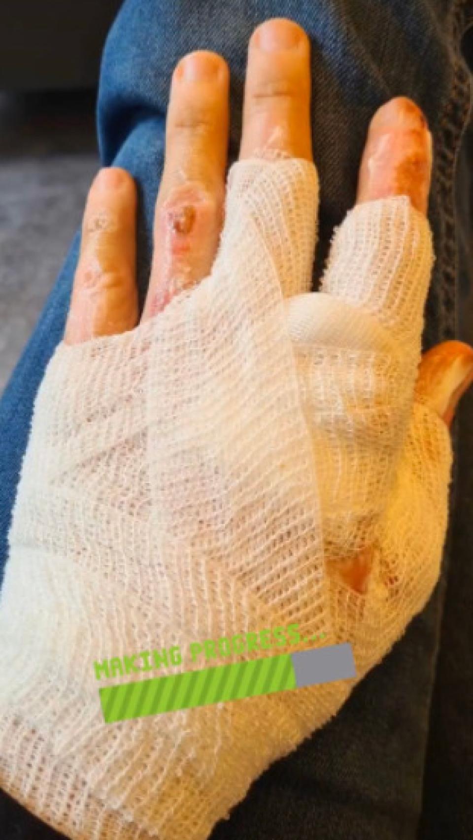 Mano izquierda de Grosjean, vendada por las quemaduras