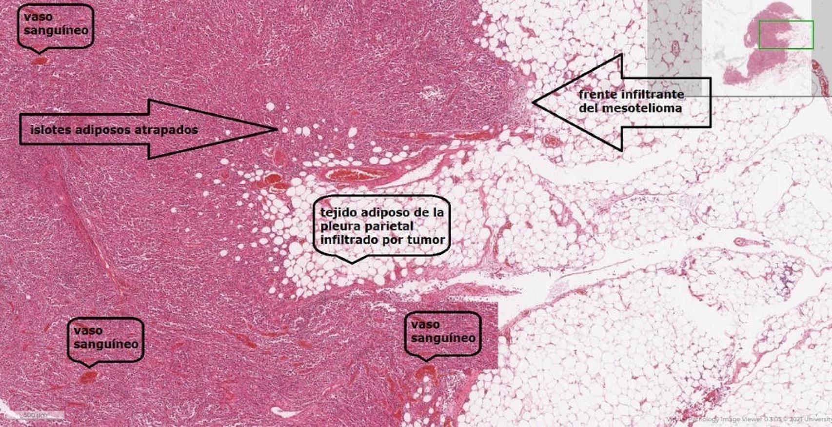 Imagen histológica a medianos aumentos de un mesotelioma con elevado grado de anaplasia procedente del microscopio virtual de la Universidad de Leeds