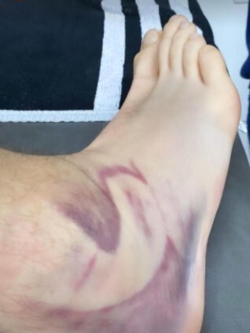 El estado del tobillo de Jaycee Carroll. Foto: Instagram (bayleecher)