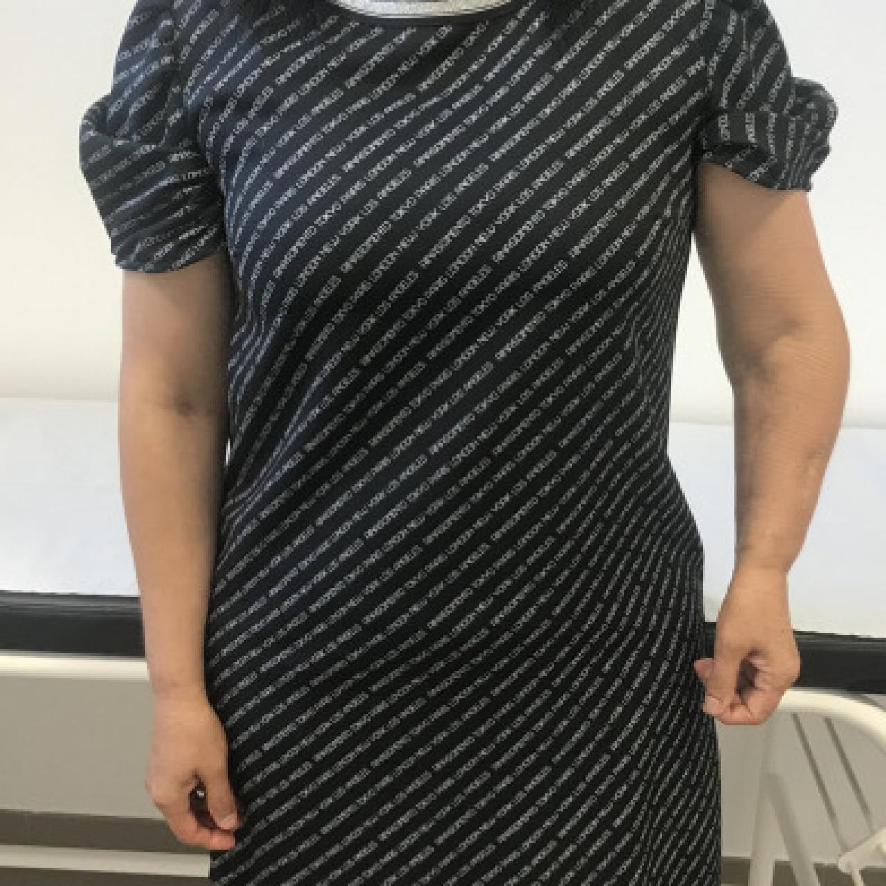 El brazo izquierdo de Carmen se ha acortado respecto del derecho debido a todas las operaciones que ha sufrido.