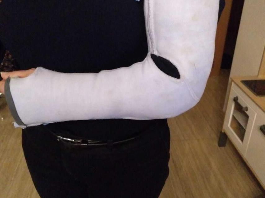 La ortesis fija que Carmen debe llevar en su brazo izquierdo porque no tiene estabilidad.