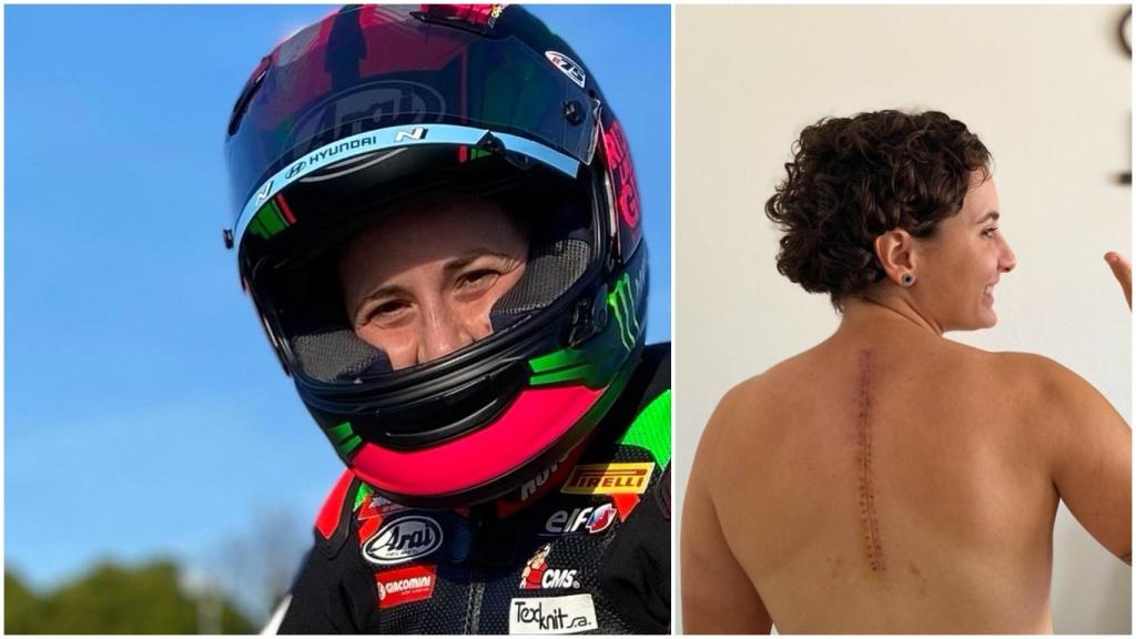 Ana Carrasco y la cicatriz tras su operación