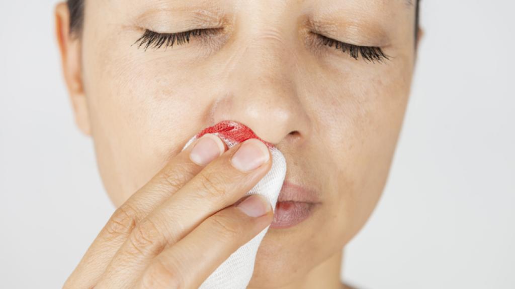 Una mujer con una hemorragia nasal.