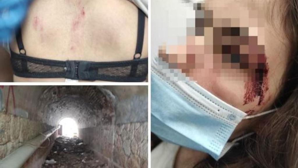 Heridas de la joven agredida