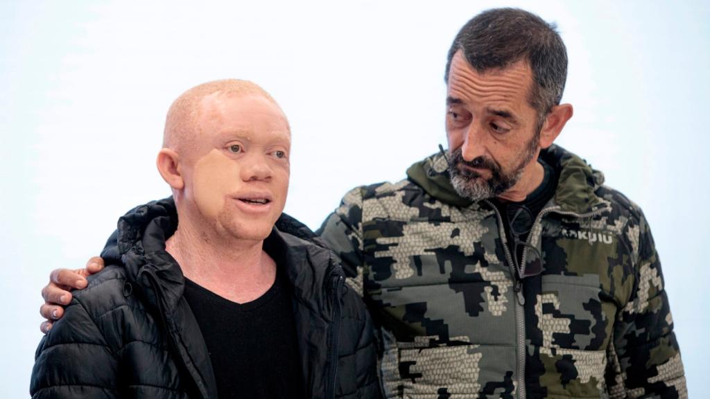 Reginaldo, el albino negro operado por Pedro Cavadas de cáncer de piel.