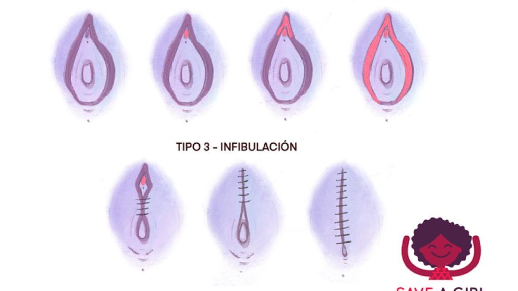 Tipos de ablación femenina.