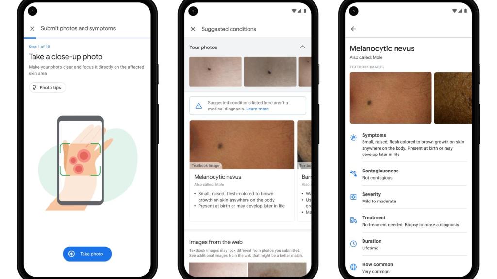 Aplicación con inteligencia artificial para detectar cáncer de piel