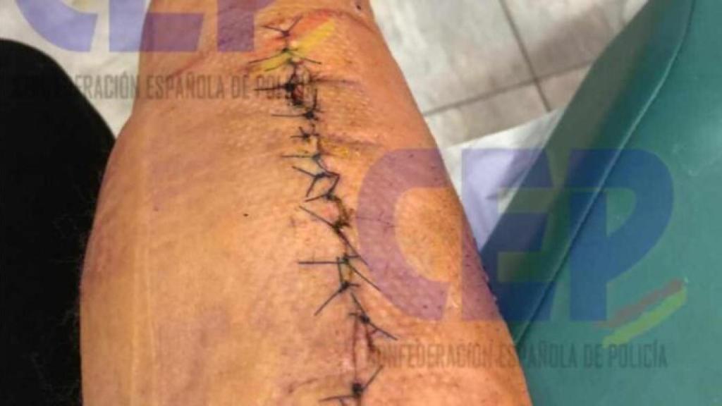 La herida perpetrada que le provocó el ataque en Urquinaona.