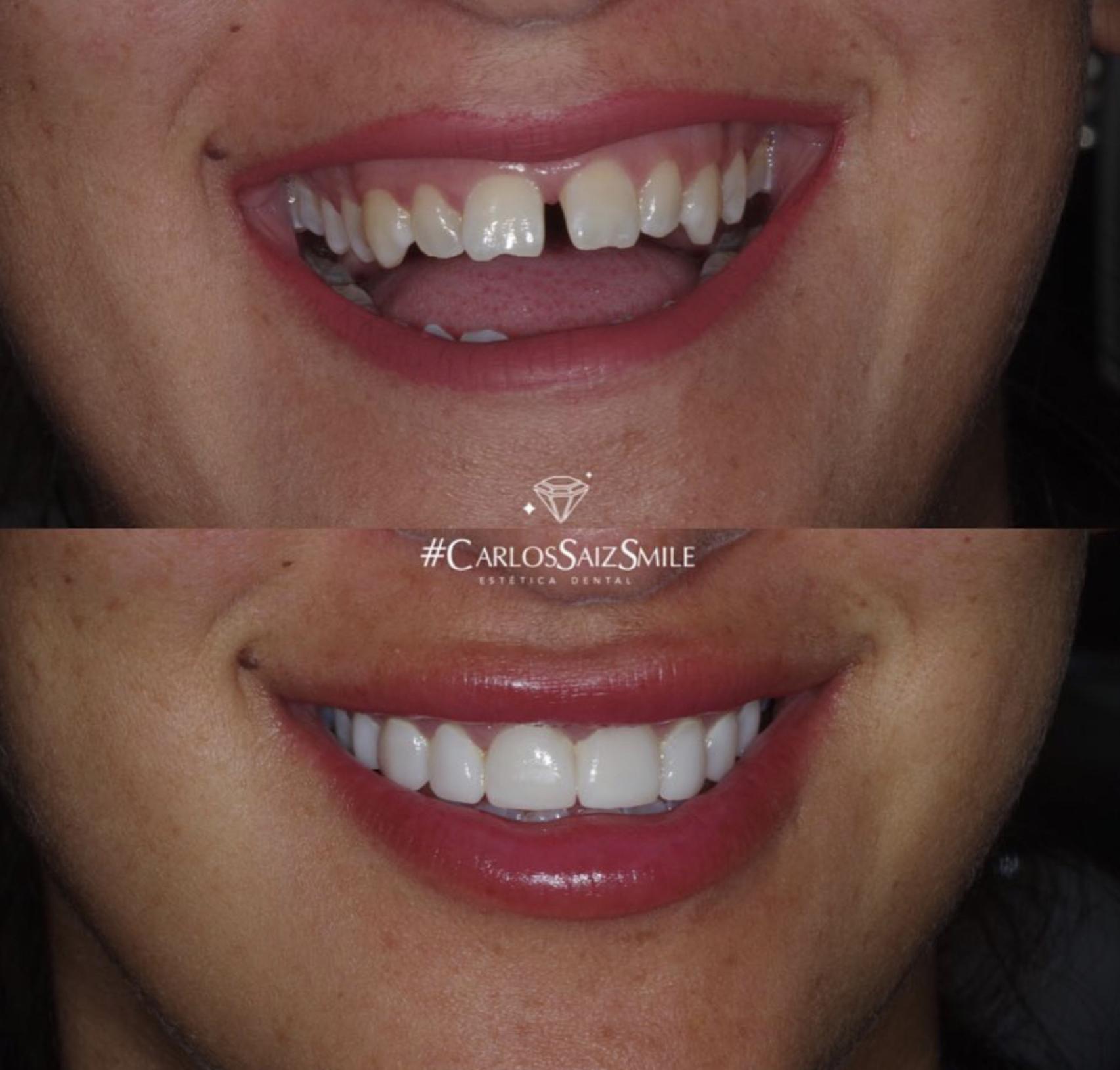 El resultado de su tratamiento de microcarillas.