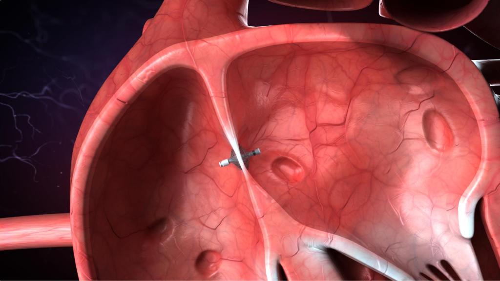 El sensor tiene un tamaño reducido y se coloca en el corazón.