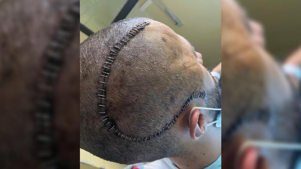 La cicatriz de Cristian tras la intervención que le salvó la vida.