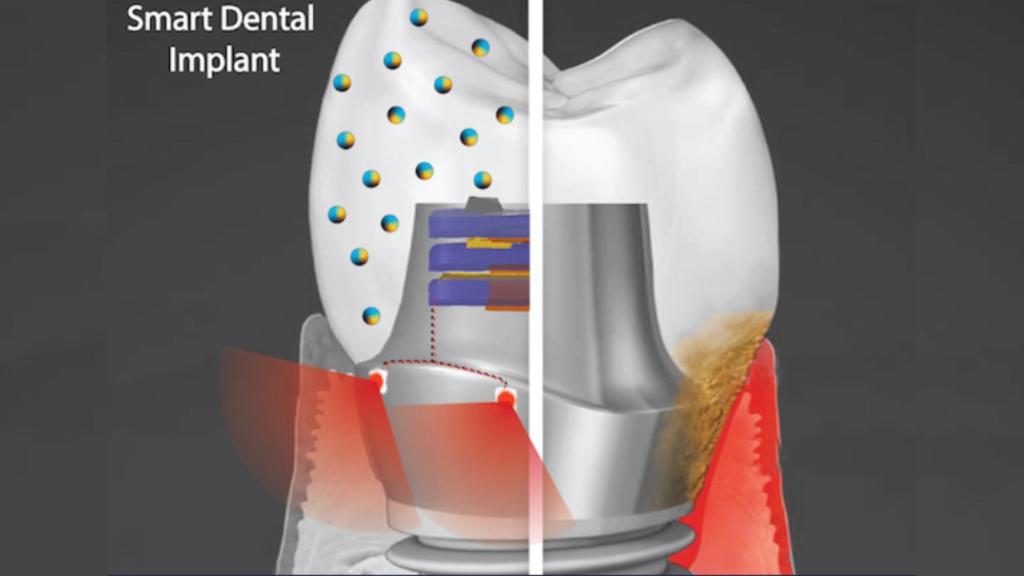Boceto del implante inteligente.