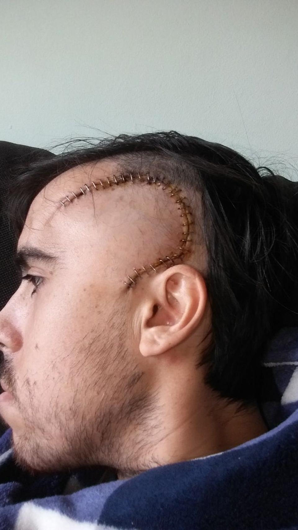 Daniel después de una de las operaciones de sus tumores