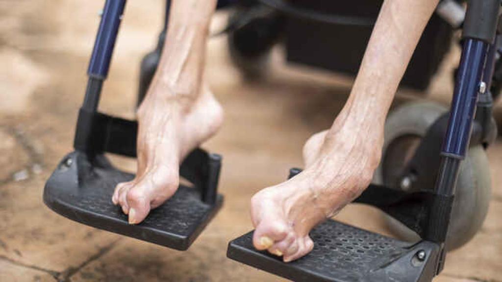 Los pies de Miguel Ángel Sánchez, atrofiados por la anilina.