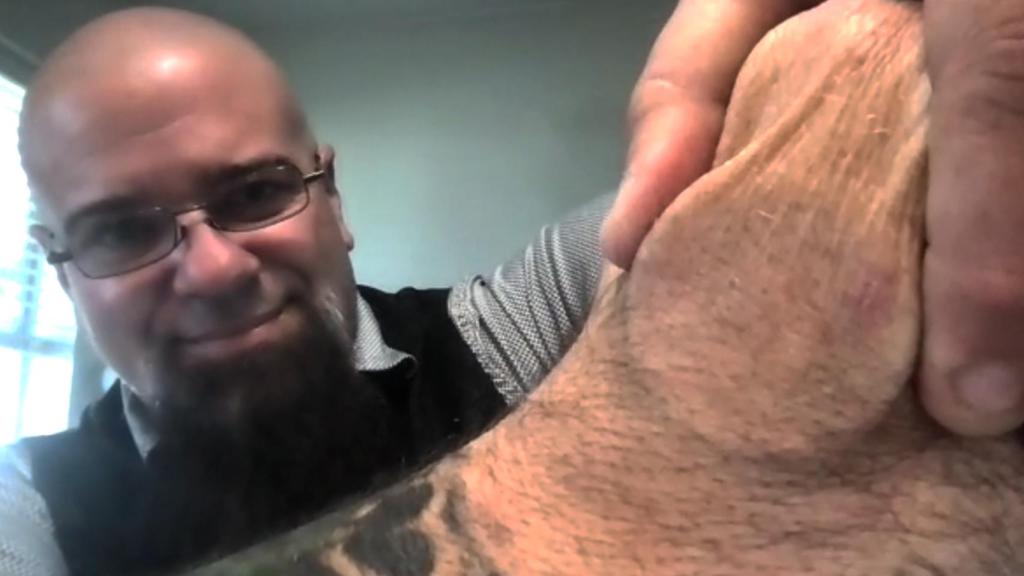 Len Noe mostrando uno de los biosensores implantados en su cuerpo.