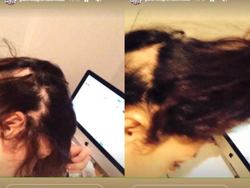 Patricia Pérez ha mostrado cómo tenía la cabeza cuando sufrió alopecia.