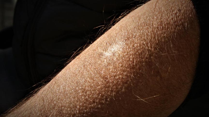 Manuel Castaño enseña la cicatriz en el brazo izquierdo de unos de los tres balazos que recibió de la Policía al detener a los atracadores que lo llevaban de rehén.