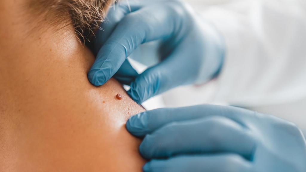 Una mujer con melanoma