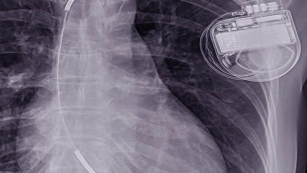 Un DAI (desfibrilador automático implantable) en una radiografía