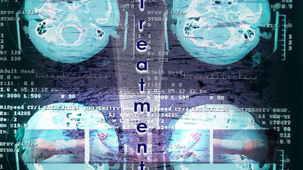 Tratamiento del ictus.