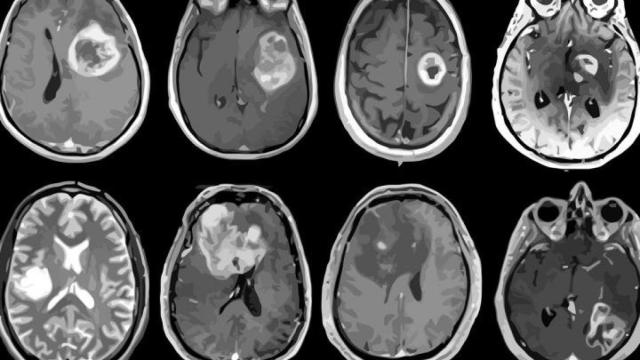 Mapa al detalle del glioblastoma, el tumor cerebral más común.